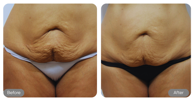 Before and after comparison