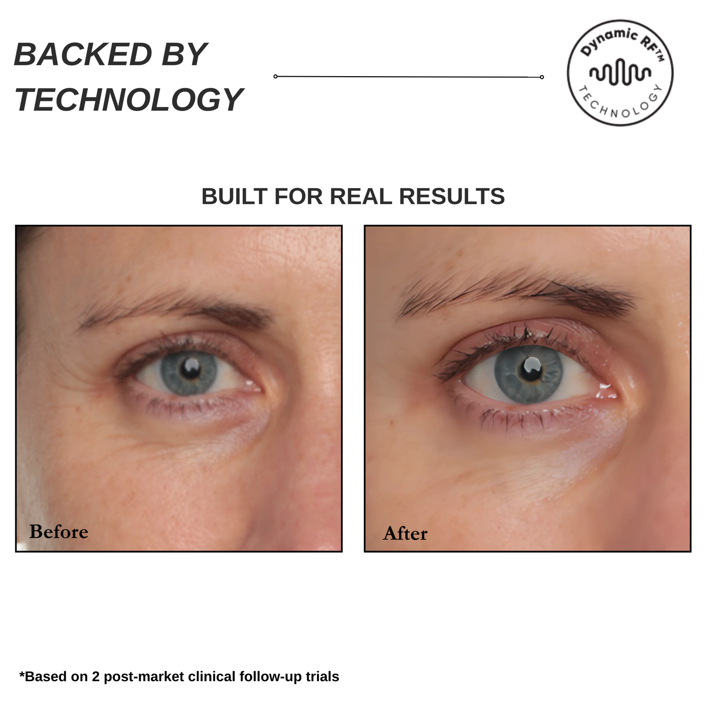 Sensilift Smart RF Skin-Firming