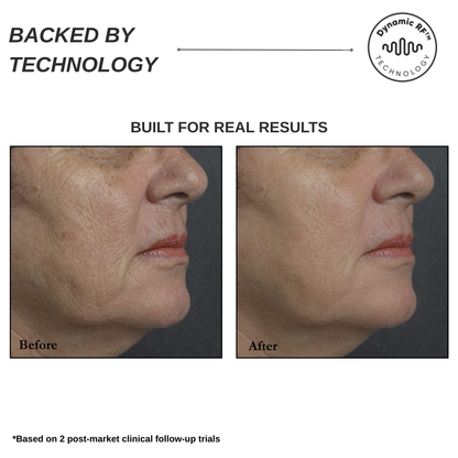 Sensilift Smart RF Skin-Firming