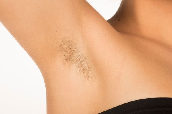 Underarms - hair removal results — Before